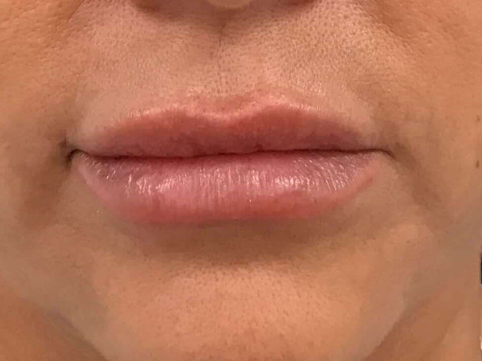 Juvederm Lip Filler After
