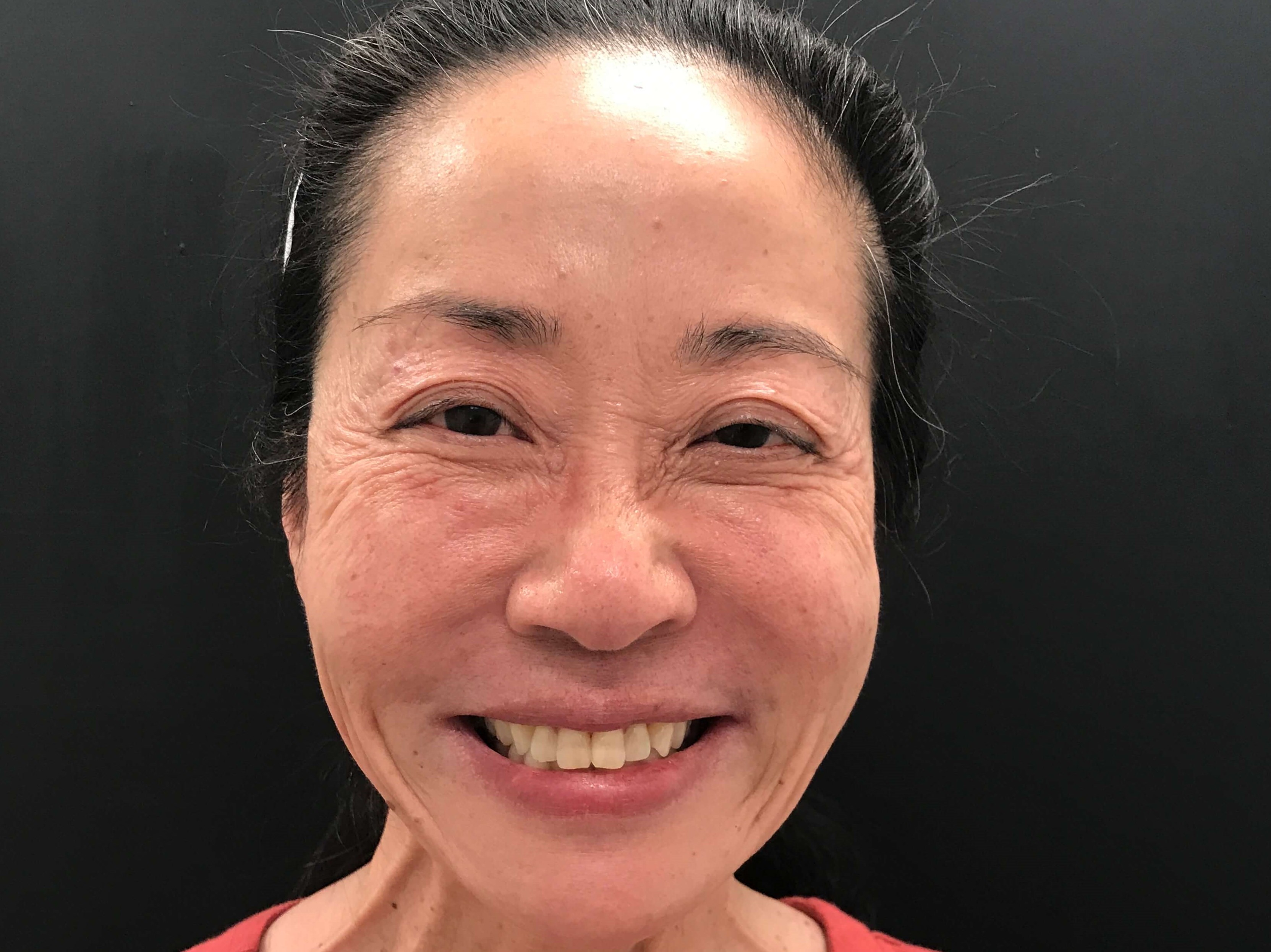 Full face rejuvenation Before