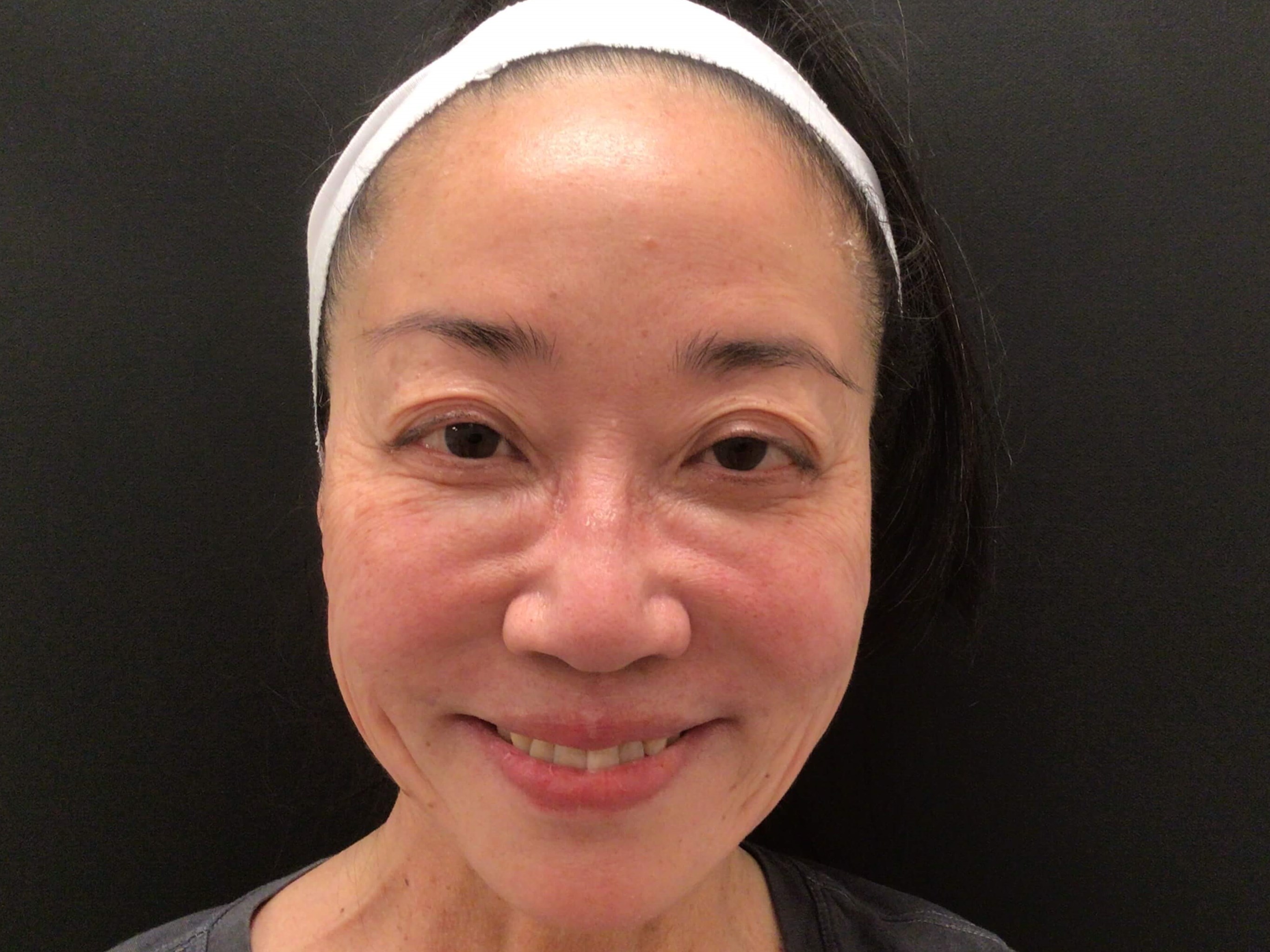 Full face rejuvenation After