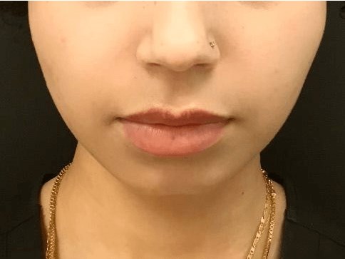 Botox for facial slimming After