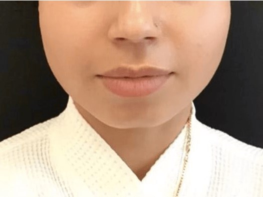 Botox for facial slimming Before