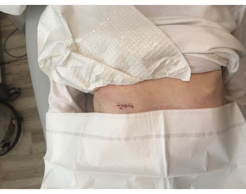 Mohs Skin Cancer Surgery Mohs closure