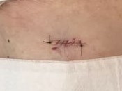 Mohs Skin Cancer Surgery After