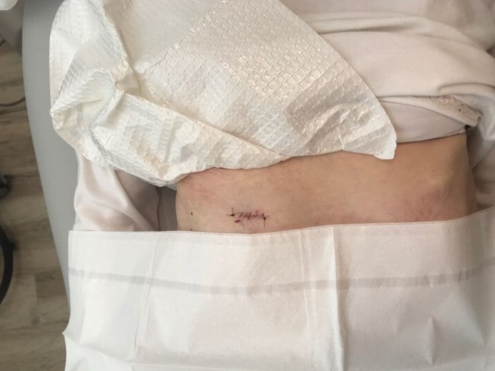 Mohs Skin Cancer Surgery Mohs closure