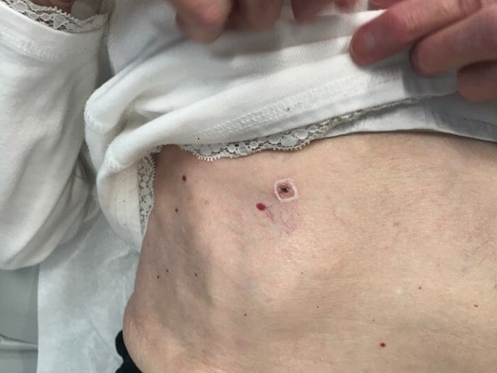 Mohs skin cancer surgery Biopsy proven Basal Cell