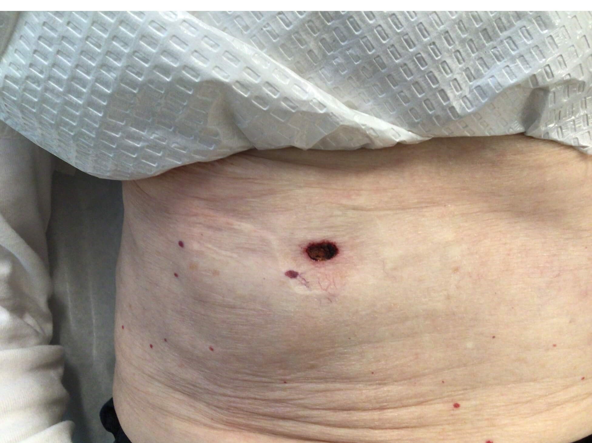 Mohs skin cancer surgery Excision by Mohs