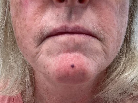 IPL treatment for hemangioma Before