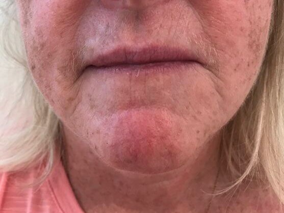 IPL treatment for hemangioma After